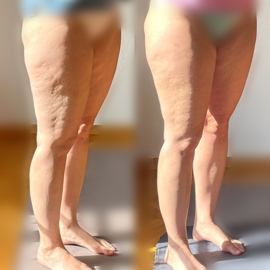 Vorher Nachher Cellulitefrei medium – Cellulite bekämpfen, Haut glatter und Beine straffer